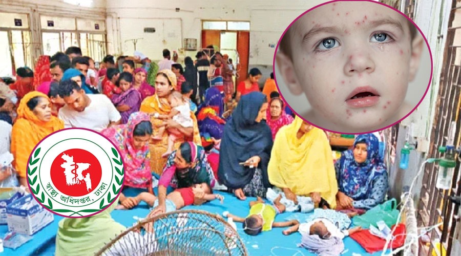 হাম উপসর্গে আরও ৫ শিশুর মৃত্যু, নতুন আক্রান্ত ৯৯২