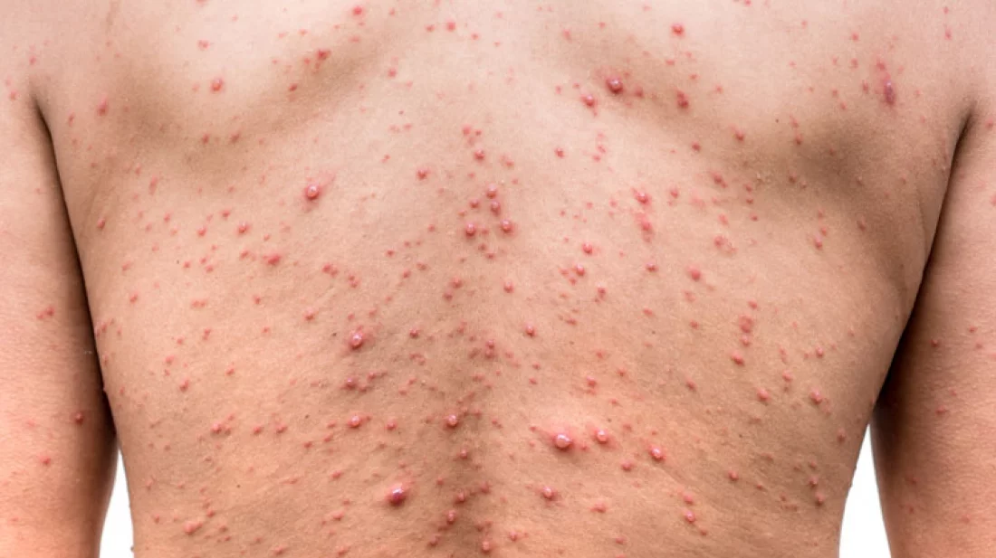 দ্রুত ছড়াচ্ছে হাম: চেনার উপায় ও প্রতিরোধের কৌশল