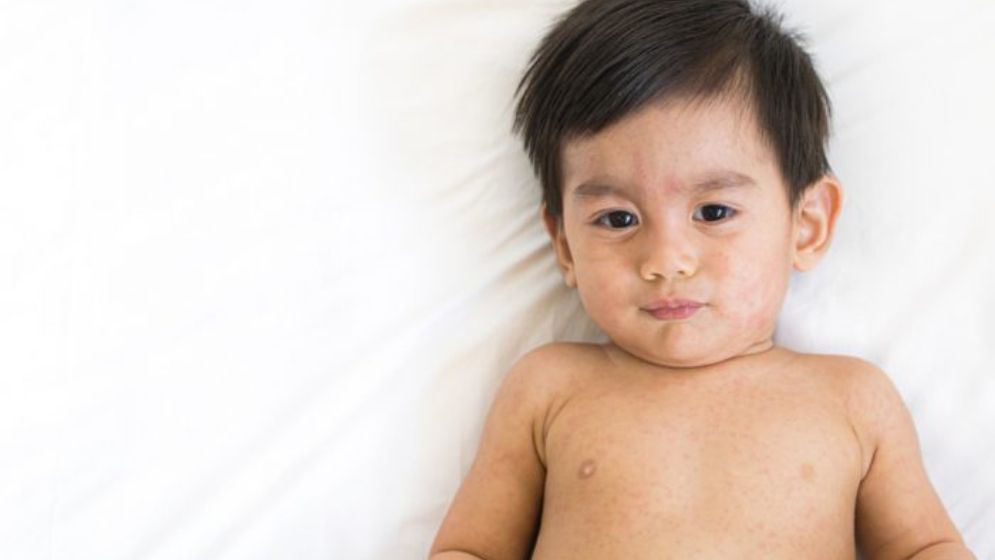 হাম থেকে বাঁচাতে শিশুর জন্য যা জানা জরুরি