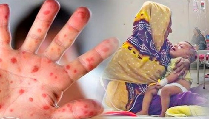 সারা দেশে ২৪ ঘণ্টায় হাম ও উপসর্গে ১১ জনের মৃত্যু