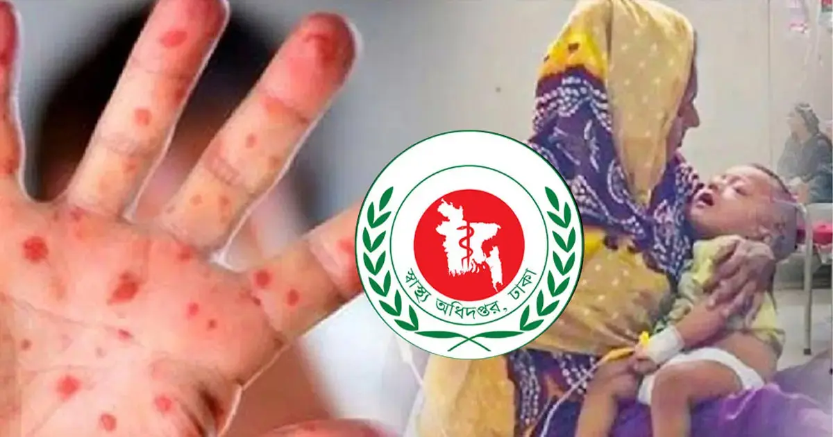 হাম উপসর্গে আরও ৫ শিশুর মৃত্যু