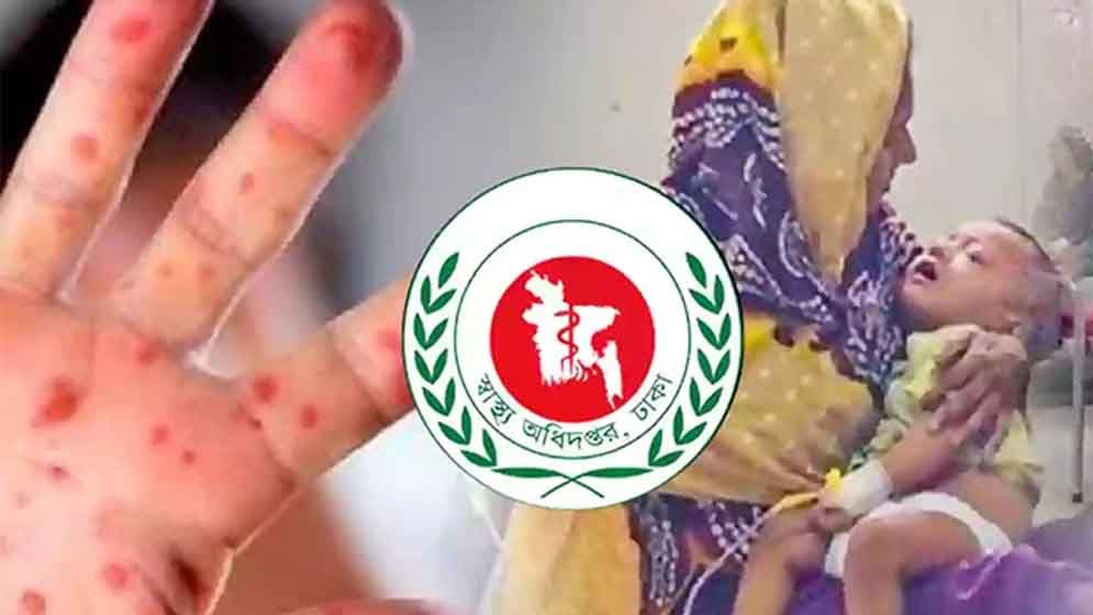 হামের উপসর্গ নিয়ে আরও ১১ শিশুর মৃত্যু