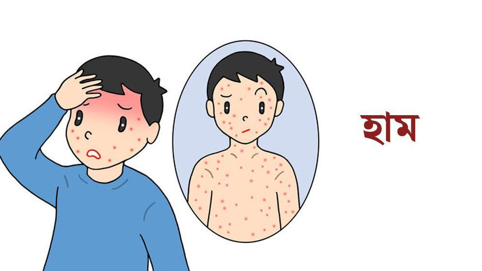 স্বাস্থ্যঝুঁকি বাড়ছে চট্টগ্রামে, একদিনে ৮ শিশুর হাম শনাক্ত