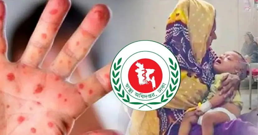 হাম ও উপসর্গ নিয়ে আরও ১৭ শিশুর মৃত্যু