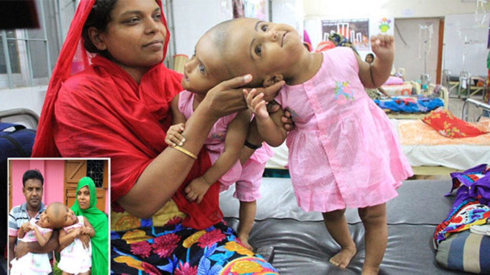 ৩০ ঘণ্টার অস্ত্রোপচারে আলাদা হলো রাবেয়া-রুকাইয়া