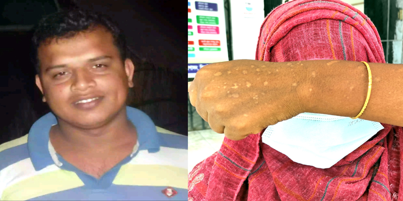 স্বামীর পরকীয়ায় তছনছ সংসার, স্ত্রীর শরীরে কয়েলের ছ্যাকা!