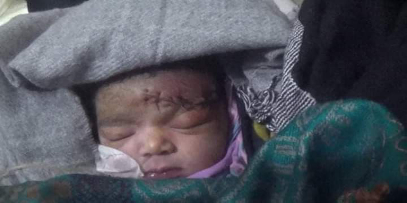 সিজার করতে গিয়ে শিশুর কপাল কেটেঁ ফেললেন আয়া ও নার্স