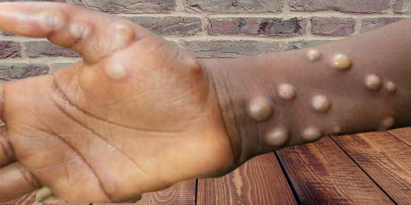 মাঙ্কিপক্সের লক্ষণ ও উপসর্গ