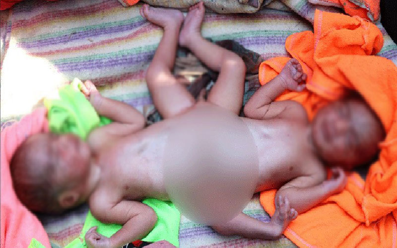 মাগুরার শ্রীপুরে দুই মাথা বিশিষ্ট এক শিশুর জন্ম